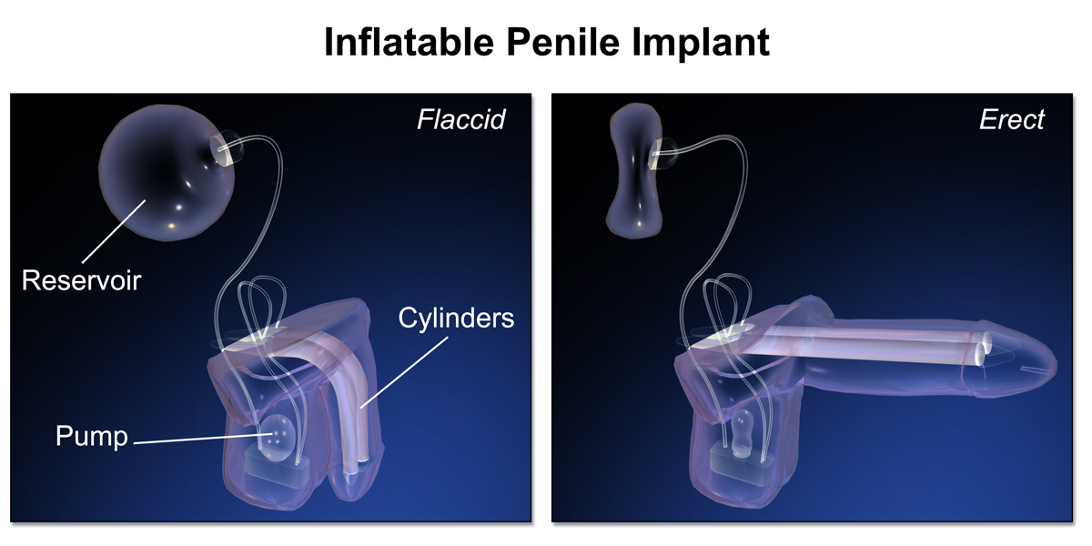 Two-piece inflatable penile prosthesis components